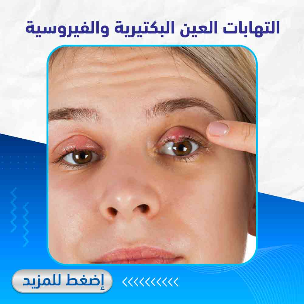 التهابات العين - صيدلية لايف كير 