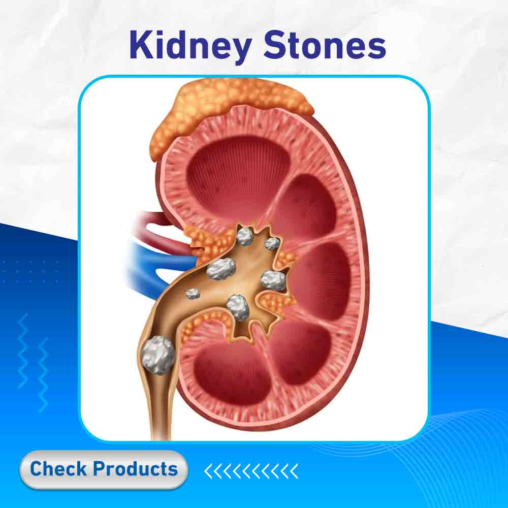 Kidney Stones - Life Care Pharmacy