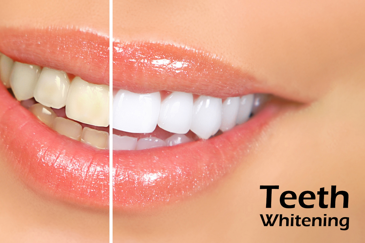 Teeth Whitening Life Care Pharmacy Online Pharmacy Kuwait