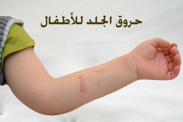 حروق الجلد للأطفال - صيدلية لايف كير 