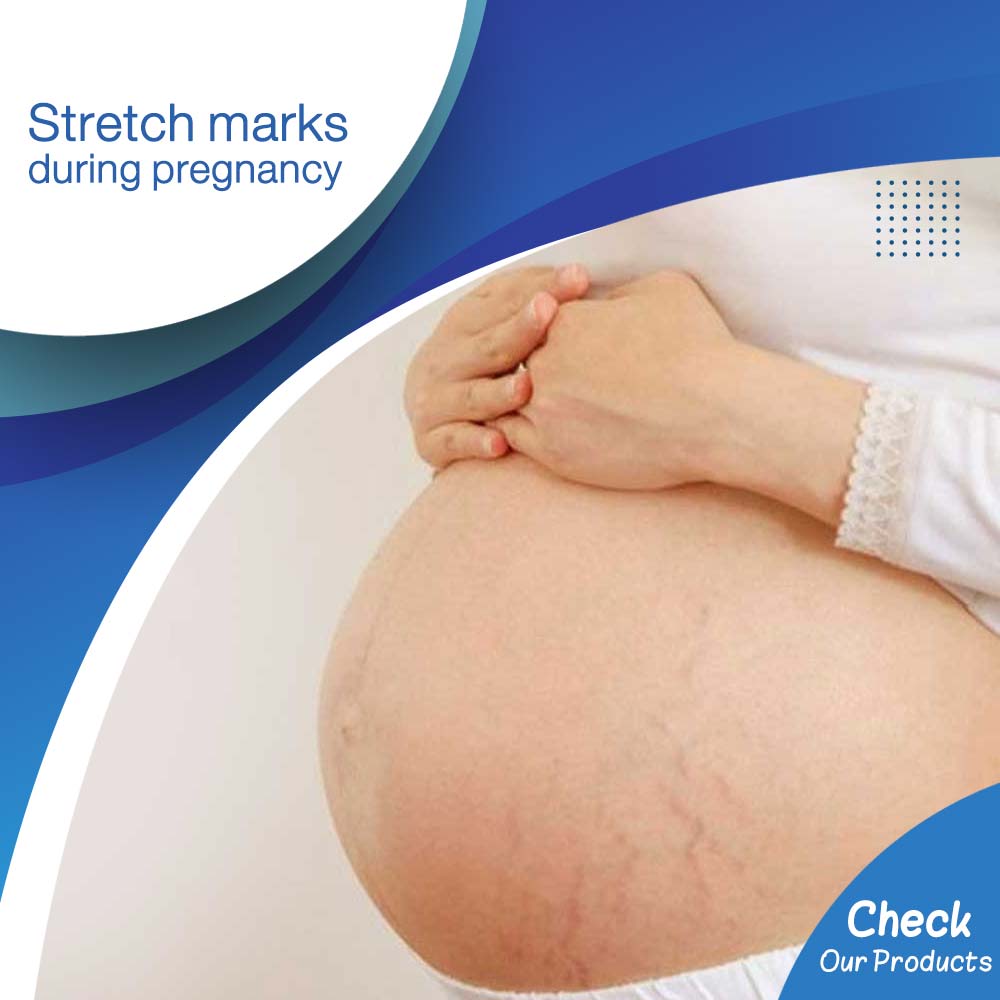 Stretch marks during pregnancy - Life Care Pharmacy
