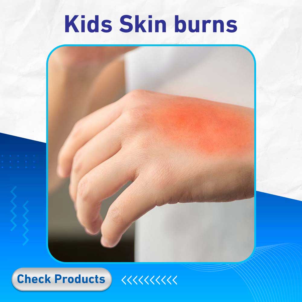 Kids Skin burns - Life Care Pharmacy